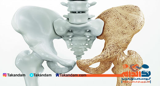 Osteoporosis-treatment-1