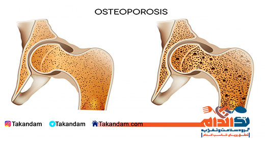 Osteoporosis-treatment-3