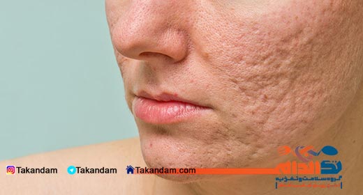 acne-and-nutrition-scar