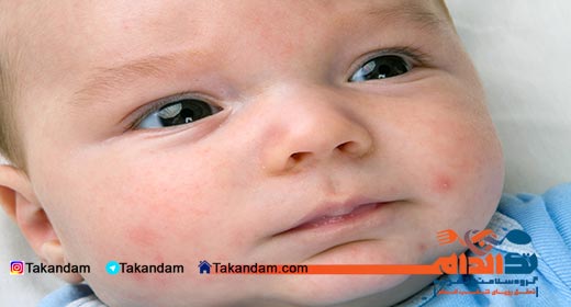 acne-cause-and-treatments-infant