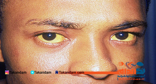 anemia-symptoms-eye