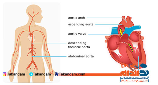 aortic-aneurysm-1