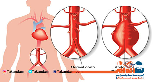 aortic-aneurysm-2
