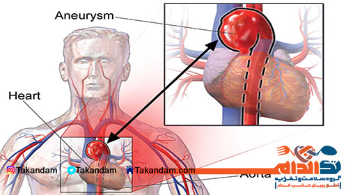 aortic-aneurysm-5