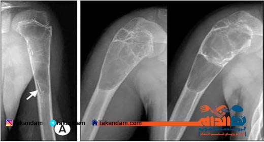 bones-tumors-shoulders