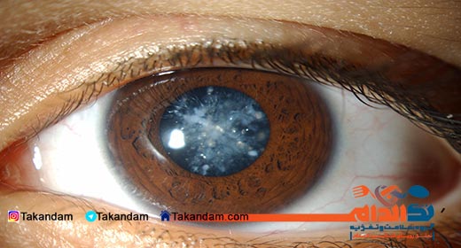 diabetes-side-effects-Cataracts