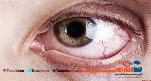 diabetes-side-effects-glaucoma