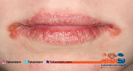 dry-lips-prevention-dry-lips