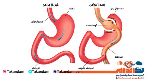 gastric-bypass-surgery-diagram