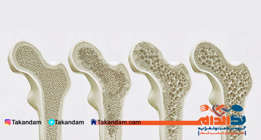 osteoporosis-cause-3