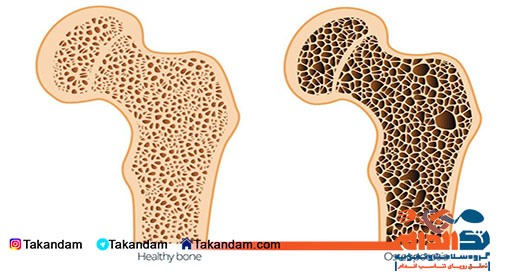 Osteoporosis-treatment-4