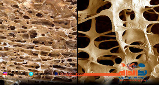 dairies-and-osteoporosis-bones