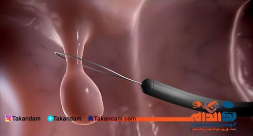 Polyps-introduction-cut