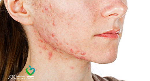 What%E2%80%99s-Causing-My-Pimple-fungal-pimple