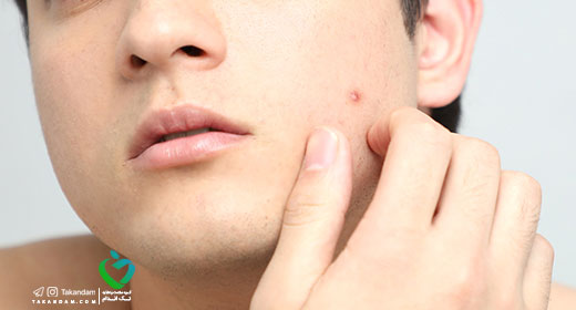 What%E2%80%99s-Causing-My-Pimple-white-head
