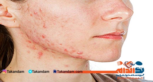 acne-and-nutrition-face