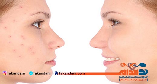acne-cause-and-treatments-comparision
