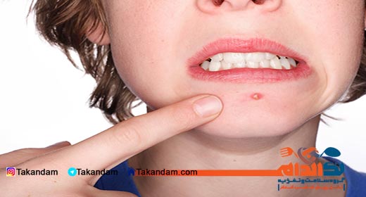 acne-cause-and-treatments-pimple