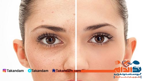 acne-cause-and-treatments-removing-makeup