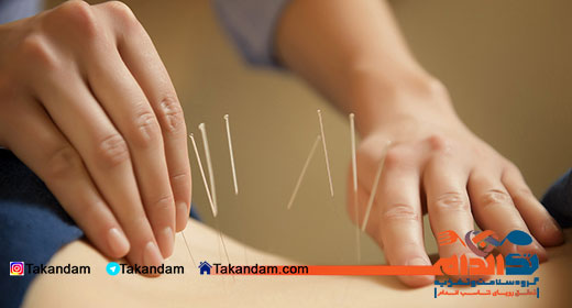 acupuncture-benefits-1