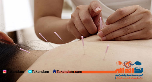 acupuncture-benefits-2