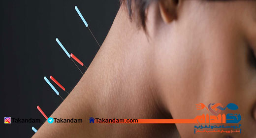 acupuncture-benefits-5