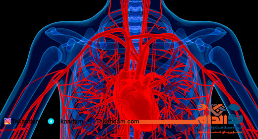 aortic-aneurysm-4
