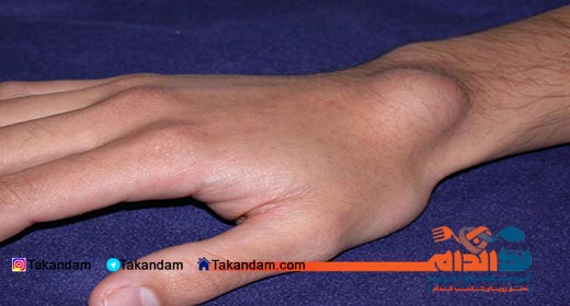 bones-tumors-hand