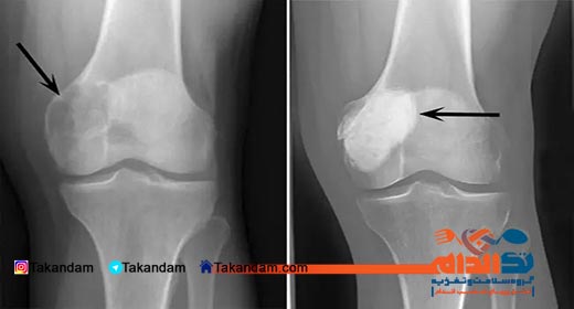 bones-tumors-xray