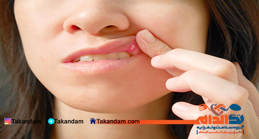 canker-sore-1