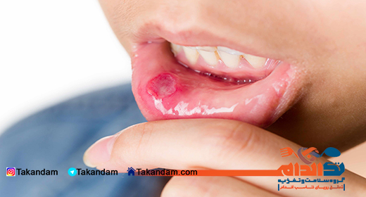 canker-sore-2