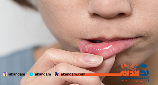 canker-sore-3