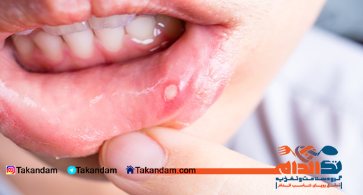 canker-sore-4