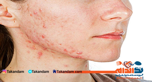 choosing-best-foundation-cream-acne