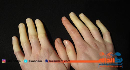 cold-hands-problem-raynaud