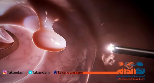 colon-polyps-diet-diagnose