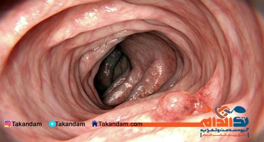 colon-polyps-diet-intestine