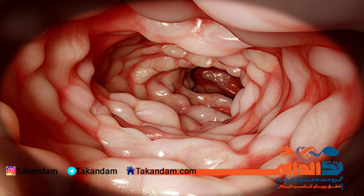 crohns-disease-symptoms