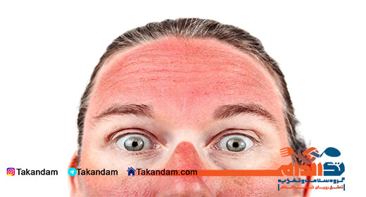 cucumber-and-skin-sunburn