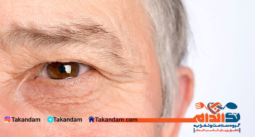 degeneration-macular-1