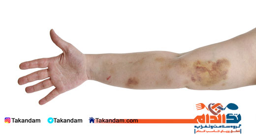 ecchymosis-arms