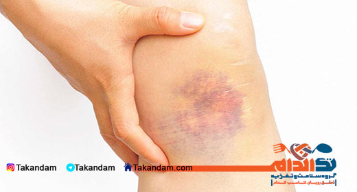 ecchymosis-elbow