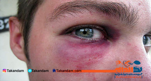 ecchymosis-eye