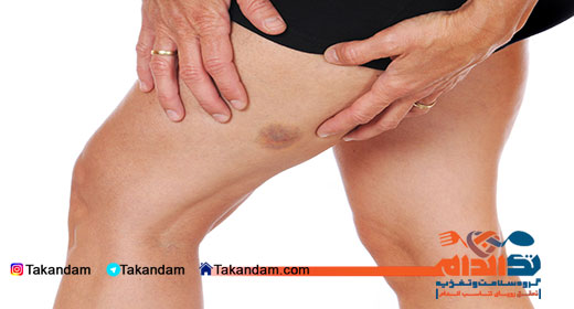 ecchymosis-legs