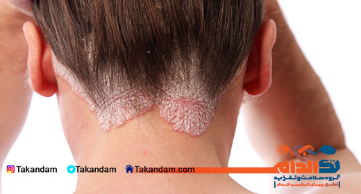eczema-treatment-1