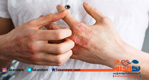 eczema-treatment-2