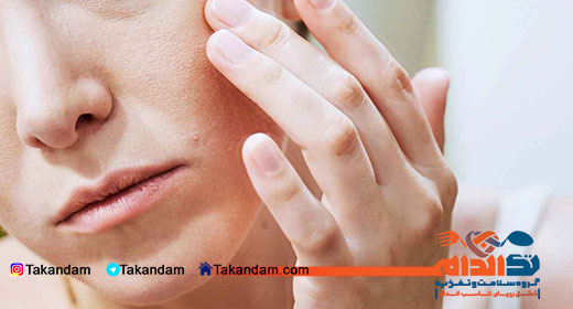 eczema-treatment-5