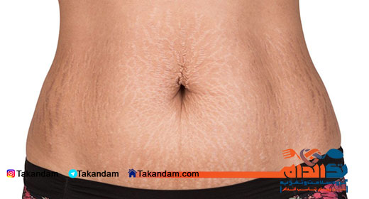 eliminating-stretch-marks-on-body-stretch-mark