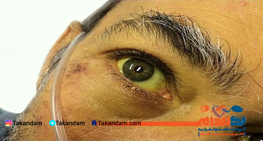 fatty-liver-treatment-skin
