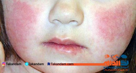 food-allergies-in-children-allergy